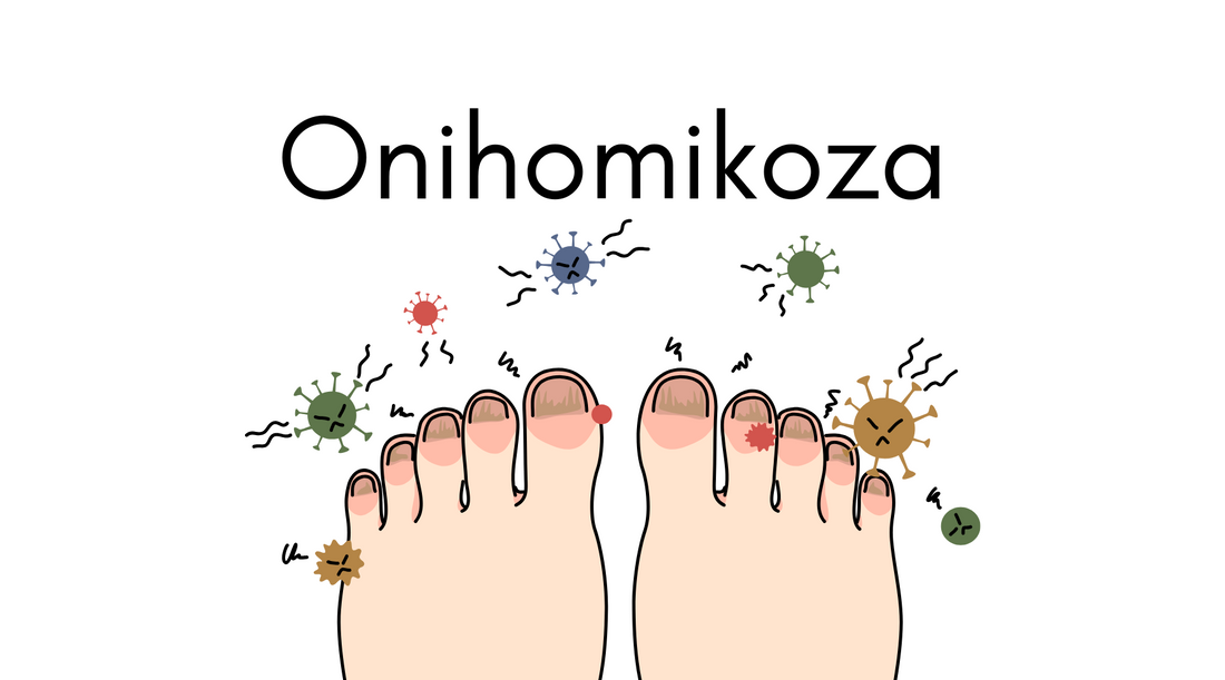 Gljivice na noktima (onihomikoza)
