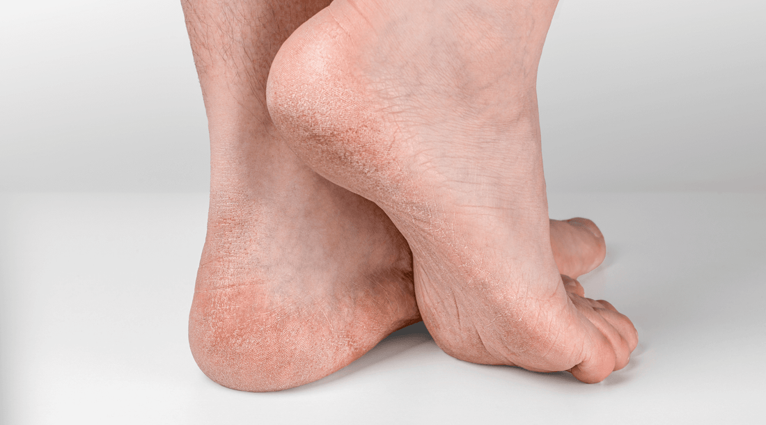 Suha koža stopala – uzroci, rizici i rješenja